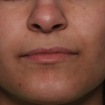 Lip Filler Before & After Patient #34996