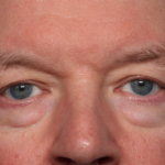 Blepharoplasty Before & After Patient #35025