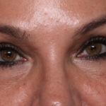 Lower Blepharoplasty Before & After Patient #35004