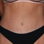 Tummy Tuck Before & After Patient #34978