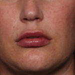 Lip Filler Before & After Patient #34979