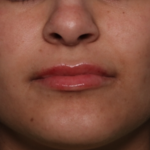 Lip Filler Before & After Patient #34996