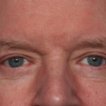 Blepharoplasty Before & After Patient #35025