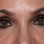 Lower Blepharoplasty Before & After Patient #35004