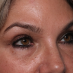 Lower Blepharoplasty Before & After Patient #35004