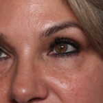 Lower Blepharoplasty Before & After Patient #35004