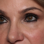 Lower Blepharoplasty Before & After Patient #35004
