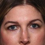 Brow Lift Before & After Patient #34929