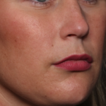 Lip Filler Before & After Patient #34979