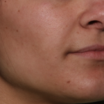 Lip Filler Before & After Patient #34996