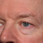 Blepharoplasty Before & After Patient #35025