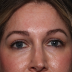 Brow Lift Before & After Patient #34929