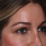 Brow Lift Before & After Patient #34929