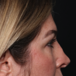 Brow Lift Before & After Patient #34929
