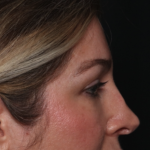 Brow Lift Before & After Patient #34929