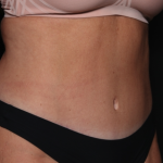 Tummy Tuck Before & After Patient #34978