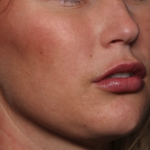 Lip Filler Before & After Patient #34979