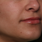 Lip Filler Before & After Patient #34996