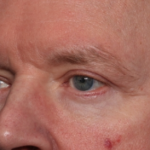 Blepharoplasty Before & After Patient #35025