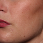 Lip Filler Before & After Patient #34979