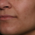 Lip Filler Before & After Patient #34996