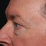 Blepharoplasty Before & After Patient #35025