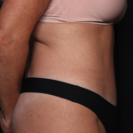 Tummy Tuck Before & After Patient #34978