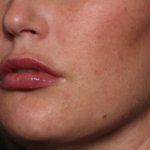 Lip Filler Before & After Patient #34979