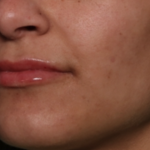Lip Filler Before & After Patient #34996