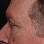Blepharoplasty Before & After Patient #35025