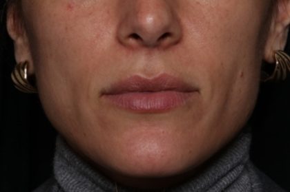 Lip Filler Before & After Patient #35117