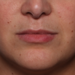 Lip Filler Before & After Patient #35036
