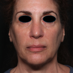 Facelift Before & After Patient #35222