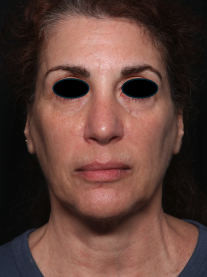 Facelift Before & After Patient #35222