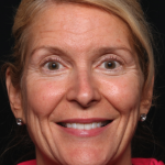 Botox and Dysport Before & After Patient #35243