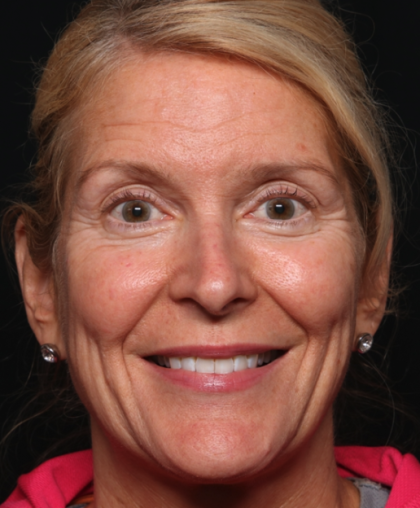 Botox and Dysport Before & After Patient #35243