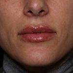 Lip Filler Before & After Patient #35117