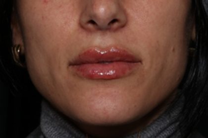 Lip Filler Before & After Patient #35117