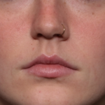 Lip Filler Before & After Patient #35054