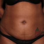 Tummy Tuck Before & After Patient #35061