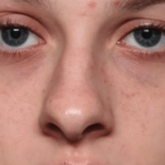 Rhinoplasty Before & After Patient #35073