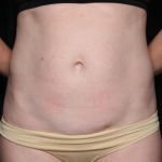 Liposuction Before & After Patient #35124