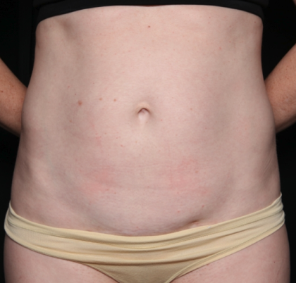 Liposuction Before & After Patient #35124