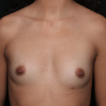Breast Augmentation Before & After Patient #35125