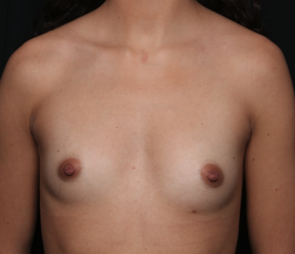 Breast Augmentation Before & After Patient #35125