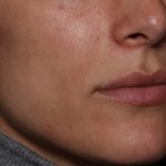 Lip Filler Before & After Patient #35117