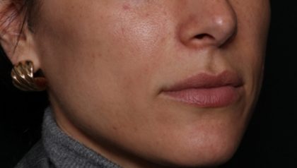 Lip Filler Before & After Patient #35117