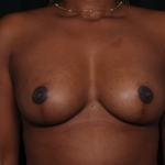 Breast Reduction Before & After Patient #35043
