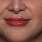 Lip Filler Before & After Patient #35036