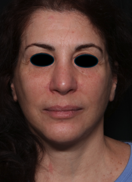 Facelift Before & After Patient #35222